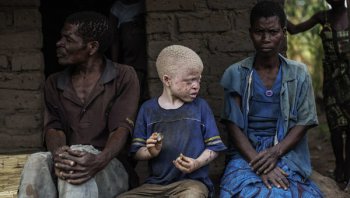 “Un autre blanc”: Albinos en África