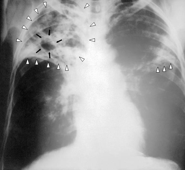 tuberculosis-x-ray_cc0.jpg